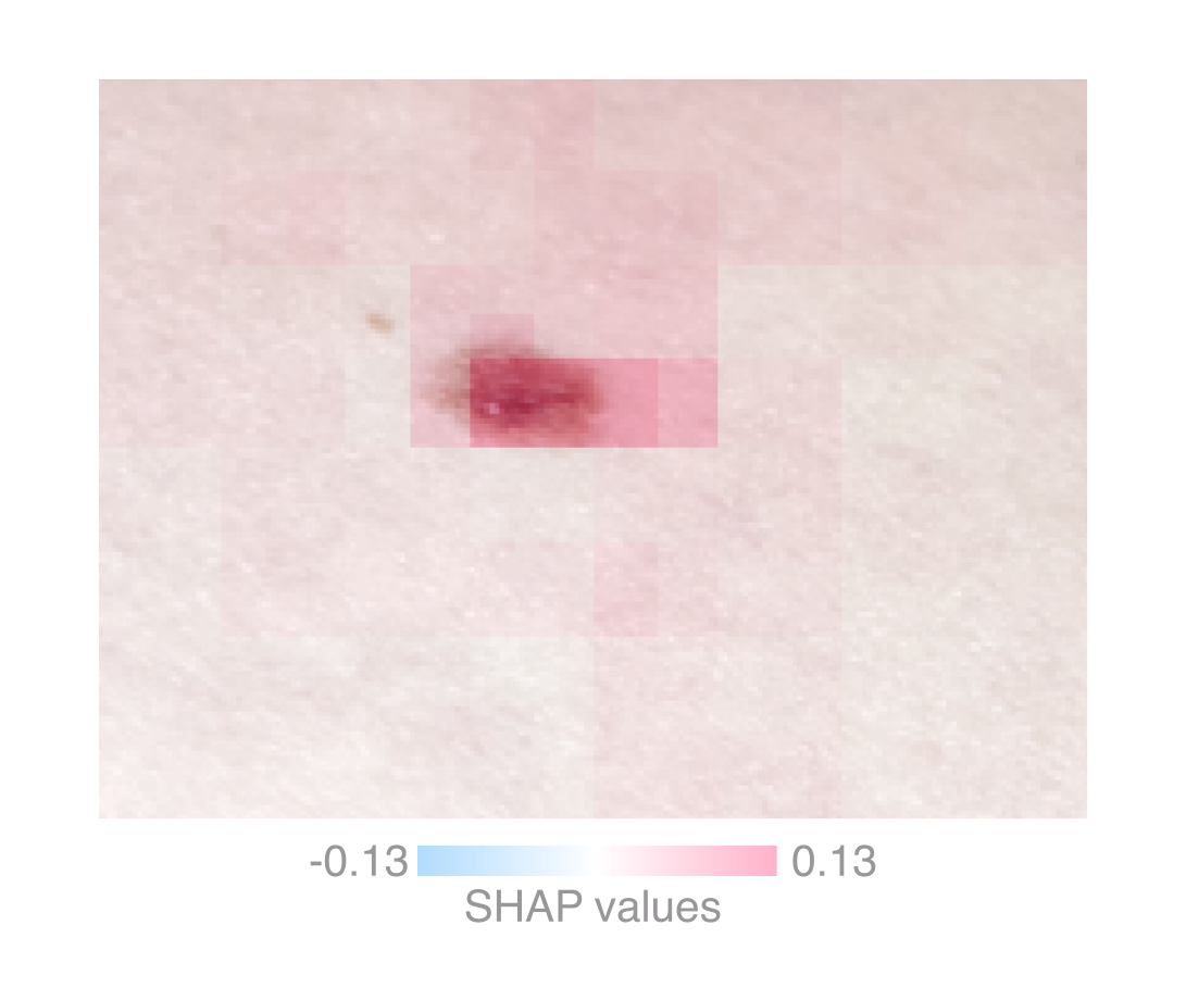 Detecting Skin Cancer